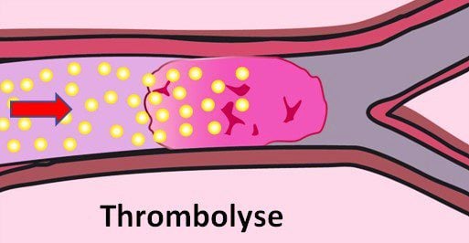 Illustration d'une thrombolyse