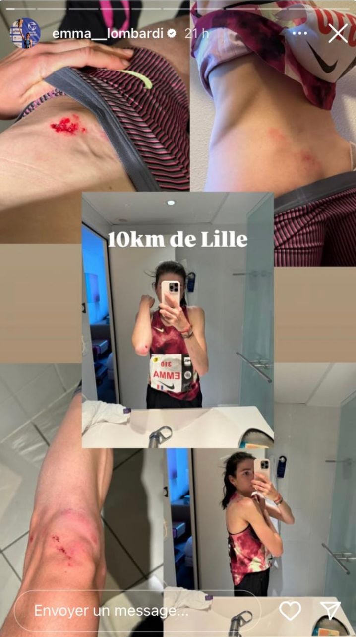 Emma Lombardi a partagé ses blessures sur Instagram.