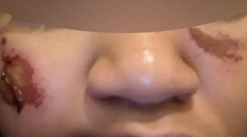 Berchem : une adolescente de 14 ans harcelée et brûlée au visage