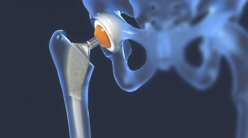 Une nouvelle arme pour éradiquer l'infection des prothèses de hanche ou de genou.