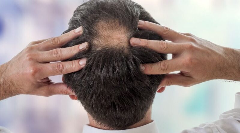 Un risque suicidaire lié à l’anti-calvitie finastéride : comment protéger les patients ?