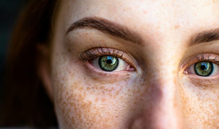 Hyperpigmentation de la peau : causes et solutions dermatologiques.