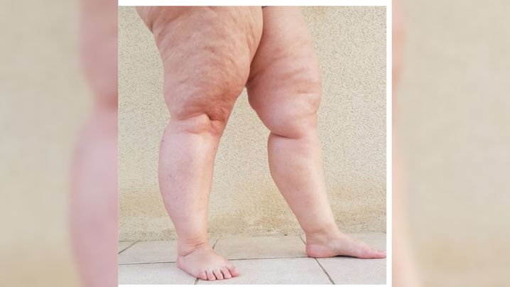 Le lipoedème, une pathologie hormono-dépendante, touche à 98 % les femmes.