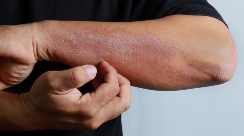 Eczéma : nouveaux traitements montrent « des progrès thérapeutiques formidables »