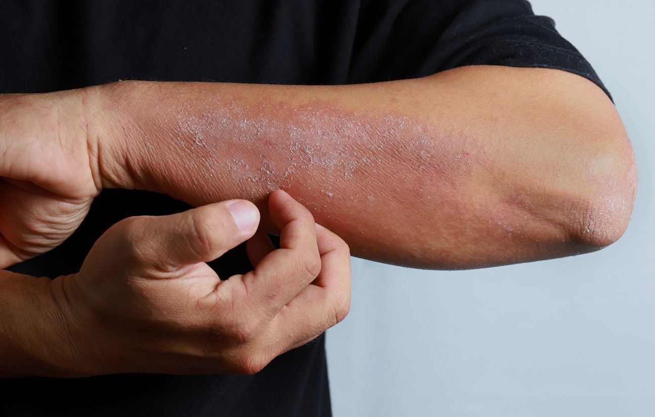 Eczéma : nouveaux traitements montrent « des progrès thérapeutiques formidables »