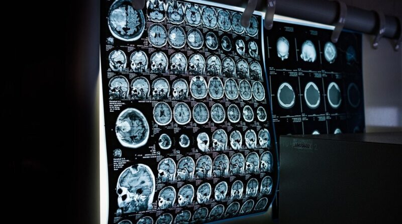 Pays de Galles : Un homme découvre un cancer du cerveau incurable grâce à sa compagne.