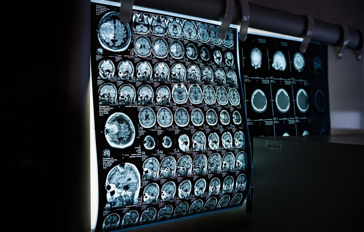 Pays de Galles : Un homme découvre un cancer du cerveau incurable grâce à sa compagne.