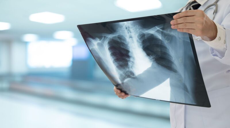 Cancer du poumon : hausse de près de 20% d'ici 2035, femmes touchées