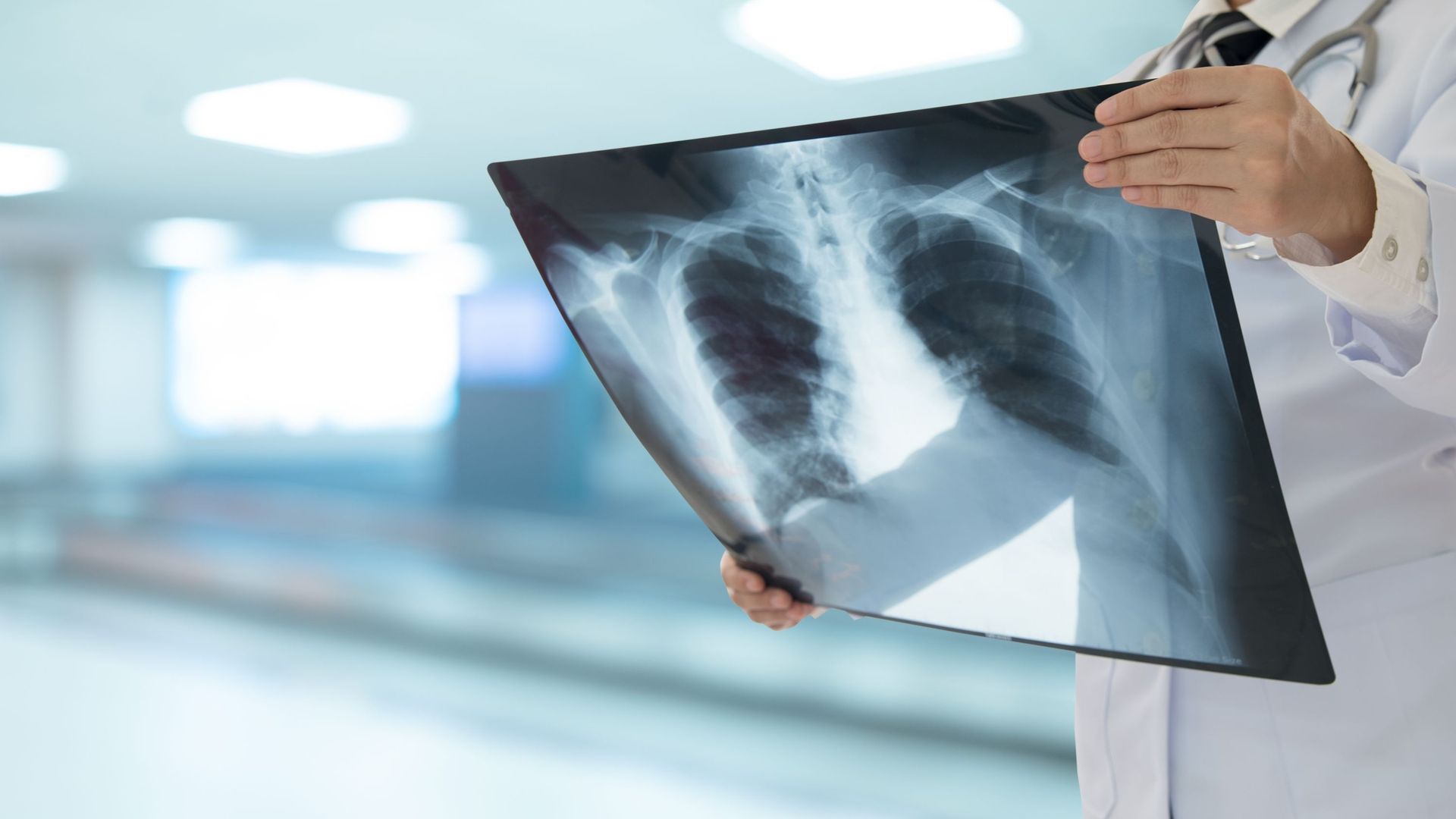 Cancer du poumon : hausse de près de 20% d'ici 2035, femmes touchées
