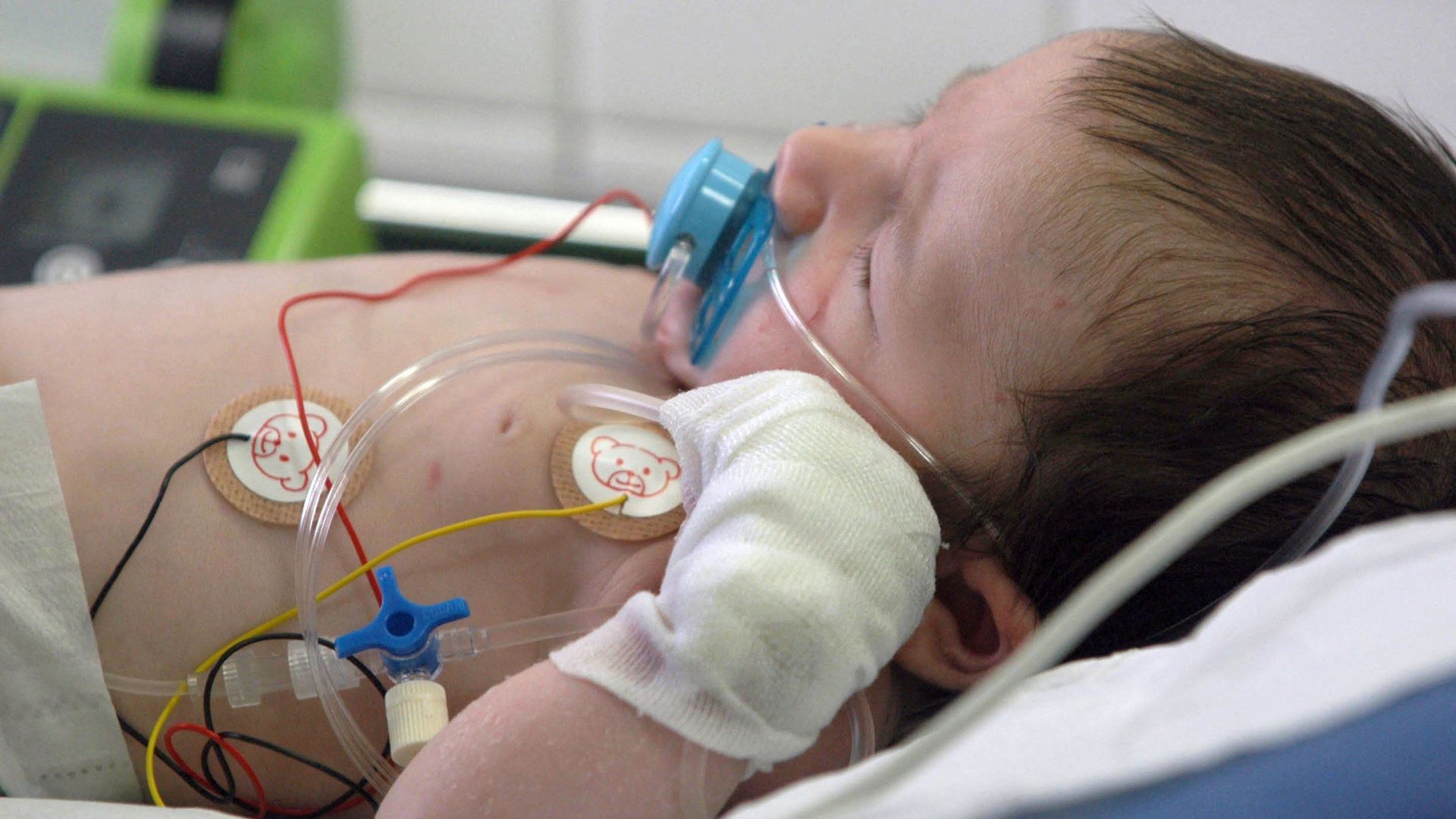 Bronchiolite : recul de 39% des hospitalisations liées au VRS chez les moins de cinq ans